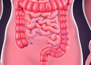 Gum Disease Bacteria May Drive Aggressive Colon Cancer